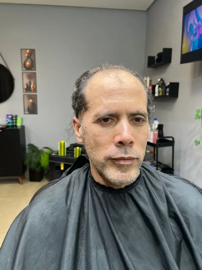 Antes da prótese capilar - Cliente 1