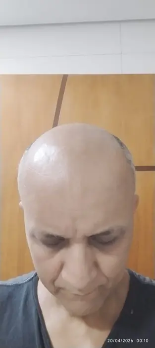 Antes prótese capilar cliente 5