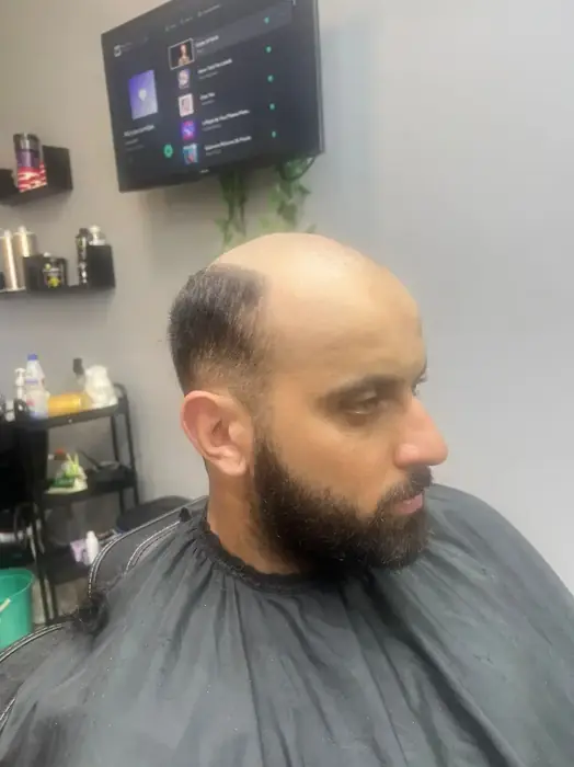 Antes prótese capilar cliente 7