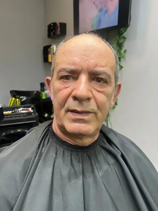 Antes prótese capilar cliente 8